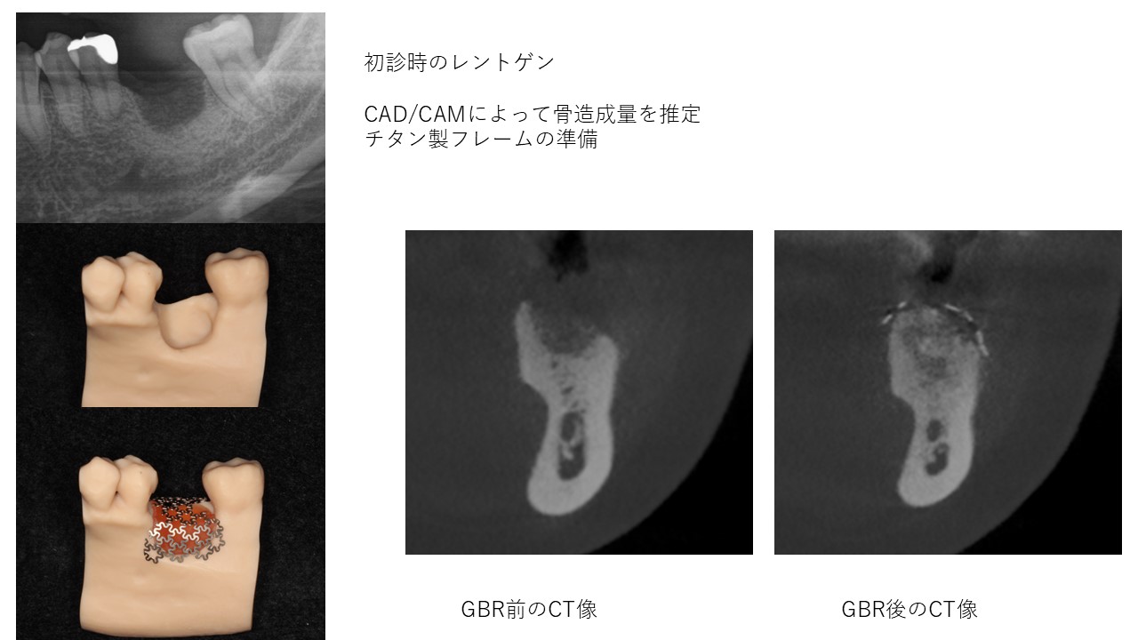インプラント