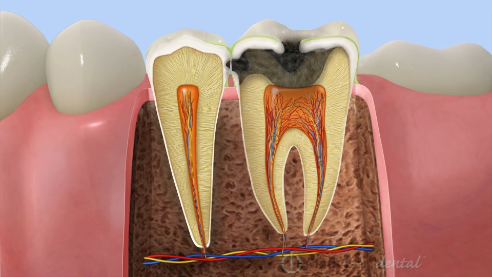 むし歯の段階と症状