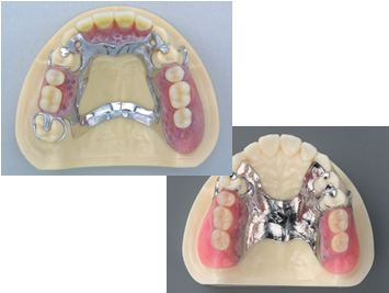 金属床部分床義歯