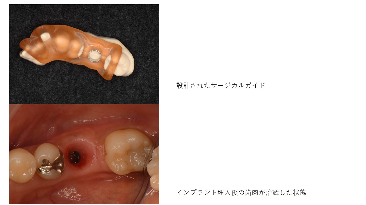 インプラント