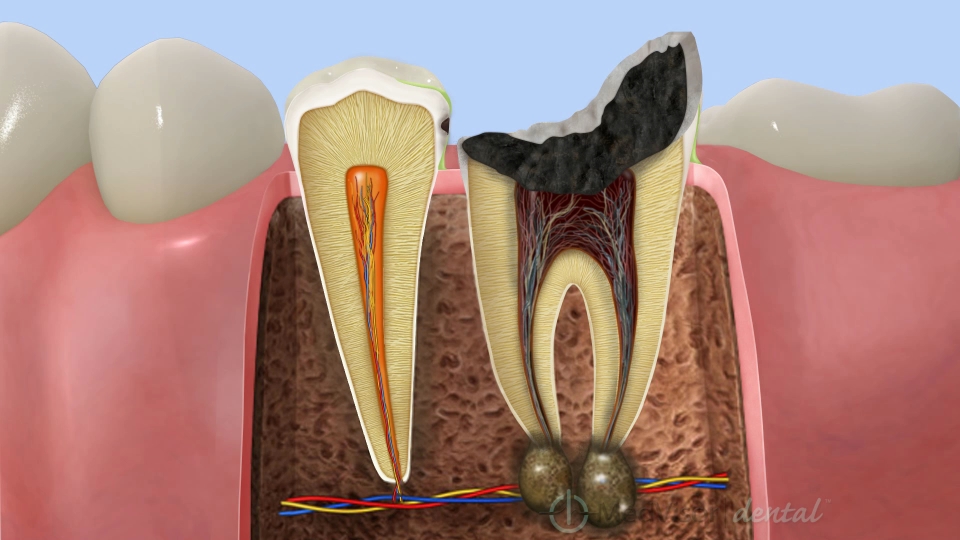 骨の中に膿をつくるむし歯（C4）