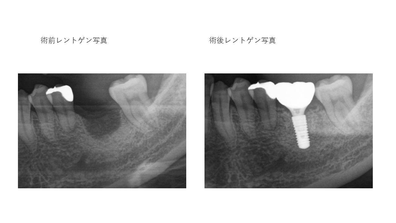 インプラント